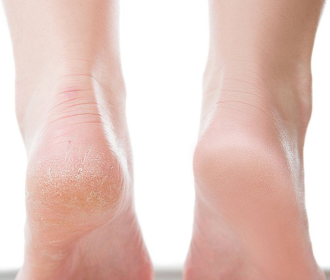 chà gót chân ủ dưỡng chất
