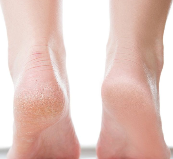 chà gót chân ủ dưỡng chất